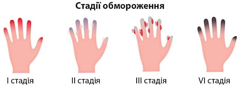 перша допомога при обмороженні